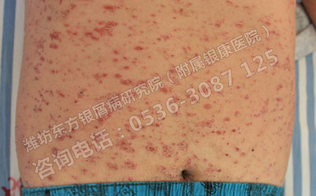 预防银屑病的措施有哪些？