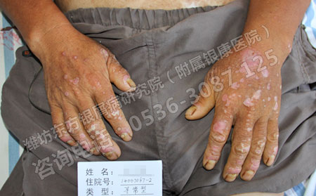 潍坊怎么预防寻常型银屑病加重病情