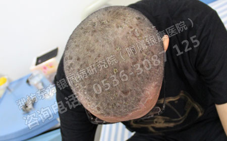 青少年头皮屑大量增多是银屑病的症状吗