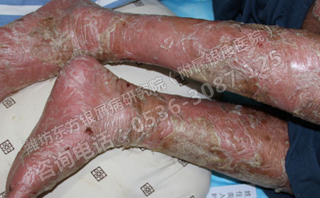让银屑病快速恢复的方法是什么