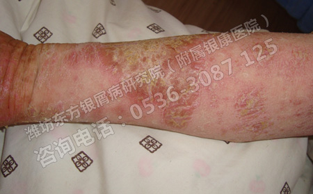 温暖的季节牛皮癣患者怎么预防反复发作