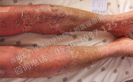 潍坊哪个医院治疗银屑病可以