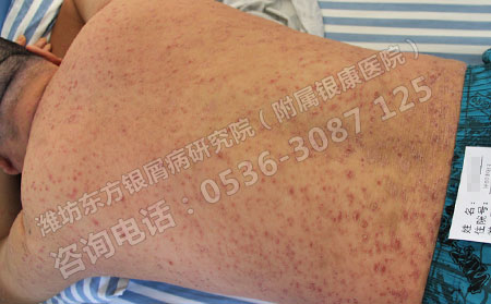 银屑病春季突发该怎么控制