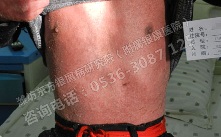 怎样降低牛皮癣对患者造成的心理危害?