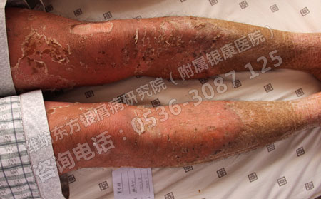 牛皮癣的典型发病症状有哪些？