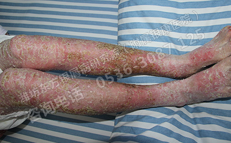 脚部出现银屑病皮损怎么预防恶化有效