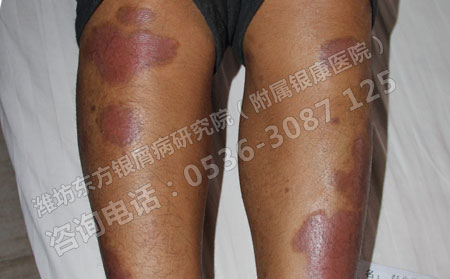 银屑病患者治疗时要注意什么