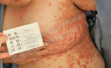 牛皮癣危害大怎么降低呢