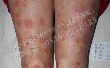 春季养肝，银屑病患者吃什么蔬菜