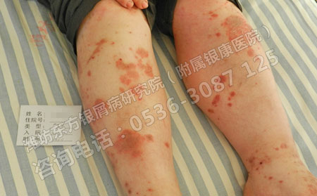 银屑病早期有哪些症状表现