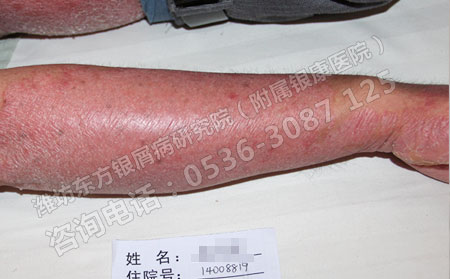 潍坊银屑病医院介绍银屑病患者的治疗须知