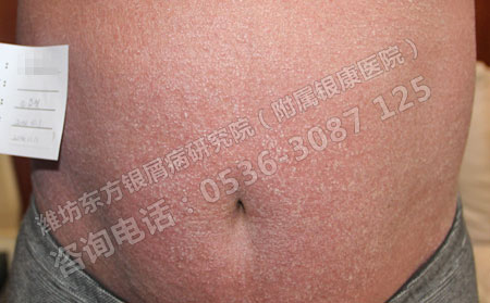 潍坊银屑病医院对引起银屑病的原因进行解析