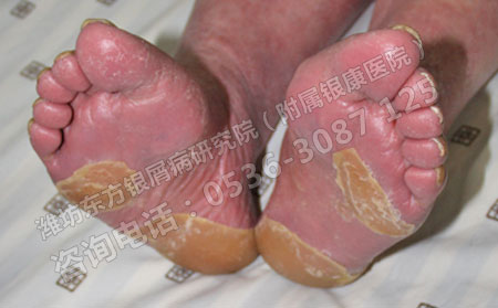 由银屑病造成的危害主要有哪些呢？