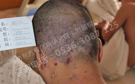 脸上出现银屑病症状时应该怎么护理？