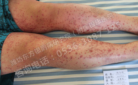 预防银屑病的发生有哪些方法