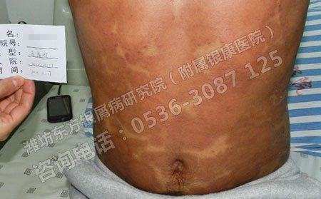 银屑病患者在消退期时有什么症状表现