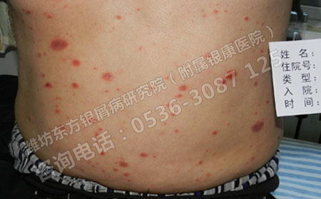 寻常型银屑病有哪些特点