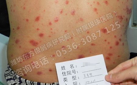银屑病的初期症状是什么样子的