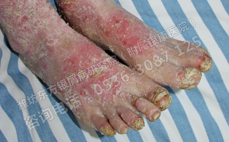 脓疱型银屑病的治疗规则有哪些