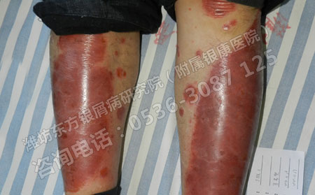 银屑病的治疗药物有什么需要注意的