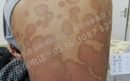 银屑病到底能不能治可以呢？