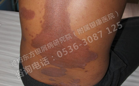 如何有效的治疗银屑病呢