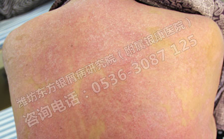 牛皮癣危害大在治疗时要注意哪些方面