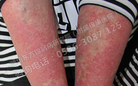 潍坊银屑病医院介绍牛皮癣的诊断方法有哪些