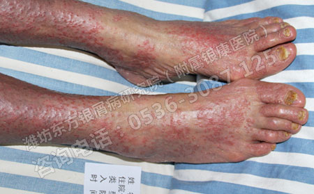 银屑病疾病的治治疗效果果怎么才能提升