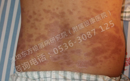寻常型银屑病还有有效治可以的可能吗