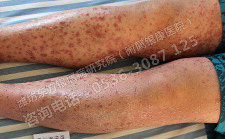 得了银屑病怎么能够尽快治可以
