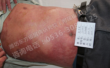 一般哪些因素会导致银屑病的发生呢？