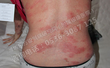 夏季怎样有效预防银屑病的发生?
