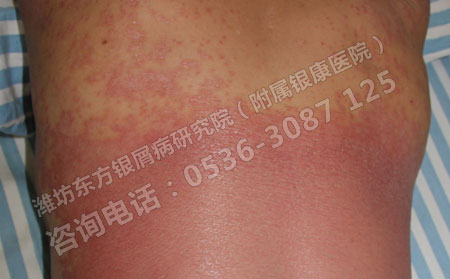 危害严重的红皮型牛皮癣的诊断方法