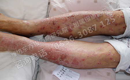 银屑病这种皮肤病怎么形成的？