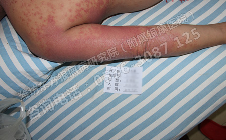 得了银屑病都有哪些禁忌