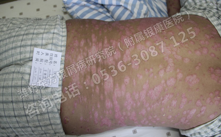 浅谈夏季预防银屑病的方法有哪些