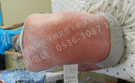 有效预防牛皮癣要采取哪些措施呢
