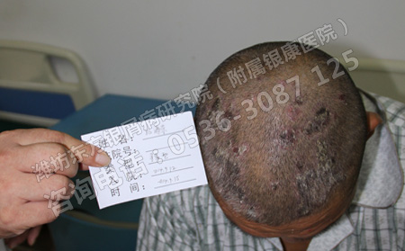 头部出现牛皮癣应该怎么办呢