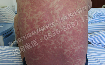 身体出现异常怎么判断是不是得了牛皮癣呢