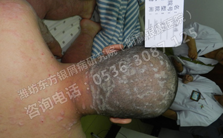 牛皮癣患者在治疗期间有哪些禁忌呢