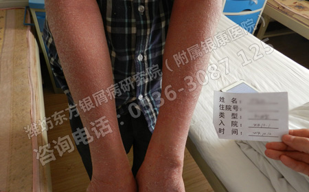治疗牛皮癣哪种方法较有效呢