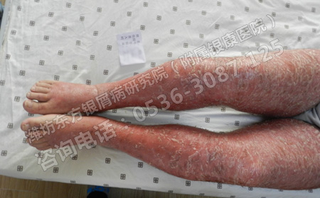 怎样判断身上出现异常是不是牛皮癣