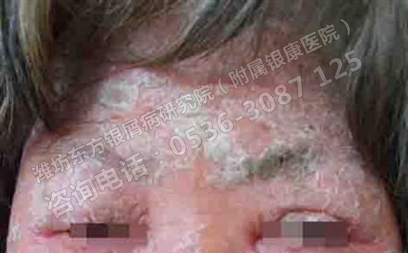 有什么么方法治疗牛皮癣有效