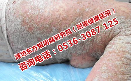 预防牛皮癣的原则是什么