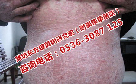 牛皮癣久治不愈怎么治可以