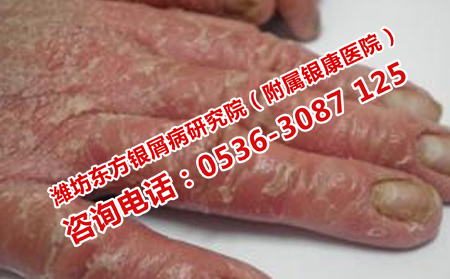 牛皮癣是否危及生命