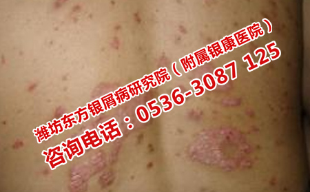 牛皮癣为什么不可以转