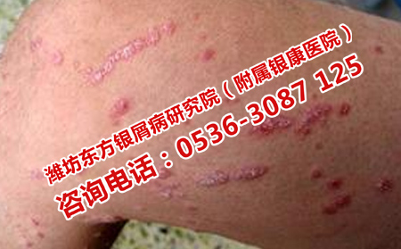 频繁发作的银屑病有什么危害
