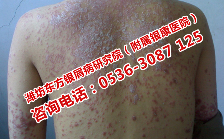 怎样预防难缠的银屑病